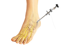 Ankle Arthroscopy