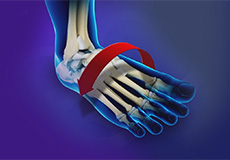 Ankle Instability Surgery