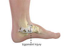 Ankle Ligament Injury