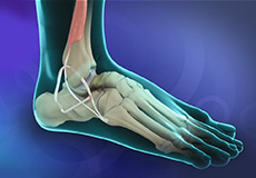 Ankle Ligament Reconstruction