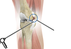 Arthroscopic Reconstruction of the Knee for Ligament Injuries