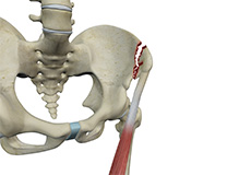 Avulsion Fractures of the Pelvis