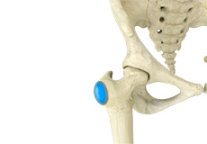 Hip Bursitis