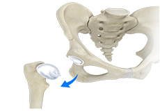 Hip Dislocation