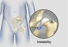 Hip Instability