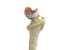 Hip Osteonecrosis