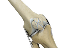 Knee Fracture Surgery