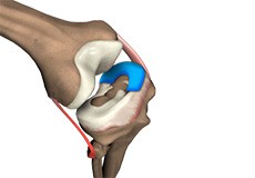 Meniscal Transplantation