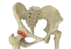 Osteoarthritis of the Hip