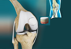 Osteochondral Allografts