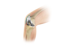 Outpatient Total Knee Replacement