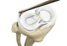 Partial Arthroscopic Meniscectomy