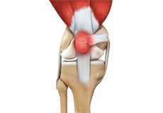 Patellofemoral Pain Syndrome