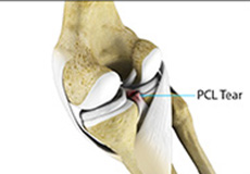 PCL Injuries