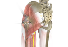 Posterior Hip Replacement