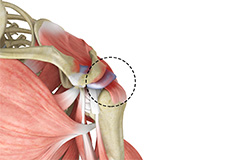 Rotator Cuff Pain