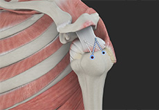 Rotator Cuff Repair