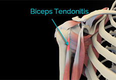 Tendinitis