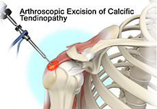 Tendinopathy Treatment