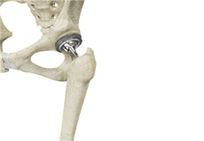 Total Hip Replacement