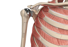 Total Shoulder Replacement