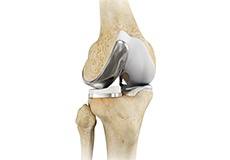 Unicompartmental/Partial Knee Replacement